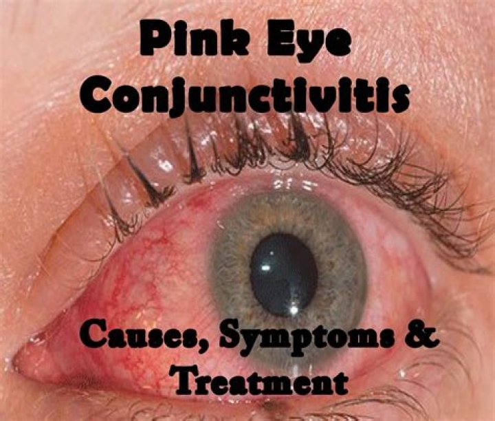 Understanding the Pink Eye Meme: Origins, Impact, and Cultural Significance